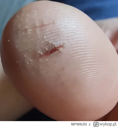 M.....B - #zdrowie #dermatologia macie jakiś patent na pękająca skóre na palcach?