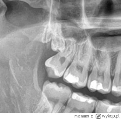 michuk9 - Czy jest to wyrastająca 9?
#stomatologia #dentysta #zeby  #stomatolog #medy...