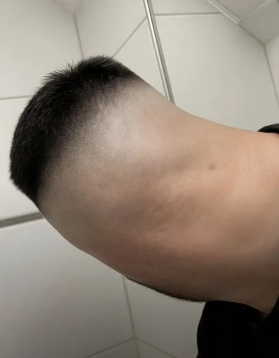 uzytkownikwykoppl - Dzisiaj mija 12 miesięcy od przeszczepu włosów, efekt lepszy niż ...