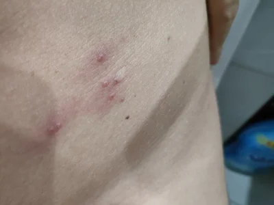 paxtax - Co to może być? Na brzuchu na dole po lewej #dermatolog #dermatologia #lekar...