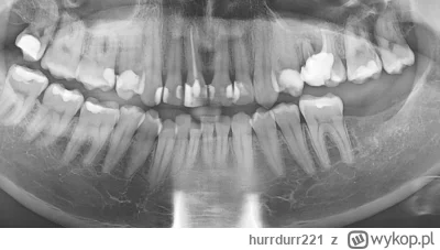 hurrdurr221 - Chciałbym się poradzić specjalistów z tagu #stomatologia Na zdjęciu pon...