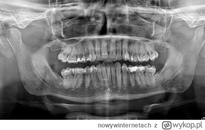 nowywinternetach - Poproszę o interpretacje RTG zębów. 5-6 dolne lewe wydają się nies...