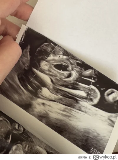 akNe - Pęcherz naszego małego Tadzia zmniejszył się znacznie.

Dalej jednak rokowania...