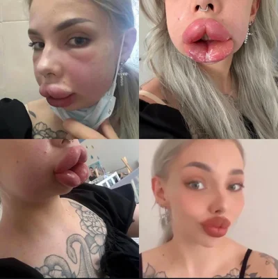 goodlife1 - @o__0 znalazlem ten post na IG, efekt „po” jest na prawym dolnym zdjeciu ...