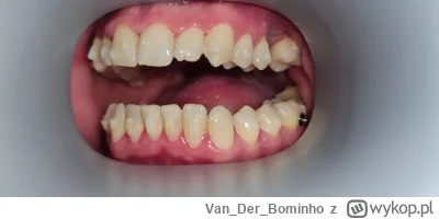 VanDerBominho - @affairz: Jasne, liczę się z tym. Jeśli chodzi o nadwrażliwość, to ju...