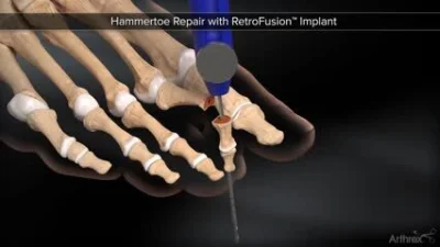 cheeseandonion - Operacja palca młotkowatego

#medycyna #stopy #deformacje  #implanty...