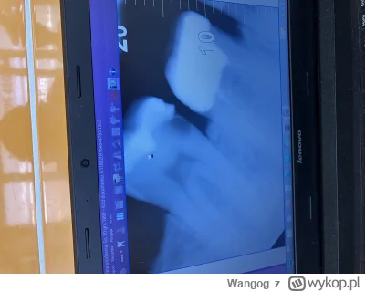 Wangog - Na poniższym zdjęciu (drugie w komentarzu) ponoć widać ze dentysta źle wykon...