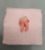 luz_arbuz98 - Podzielę się z wami jak ładnie wygiętą ósemkę stomatolog mi wyjął w cał...