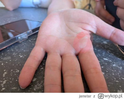 janstar - Potrzebuję porady medycznej: Żona uderzyła się od zewnętrznej strony dłoni,...