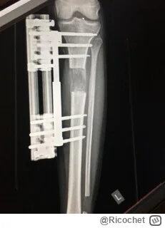 Ricochet - @kamileon25 mój kumpel wziął sprawy w swoje ręce i chirurgicznie połamał n...