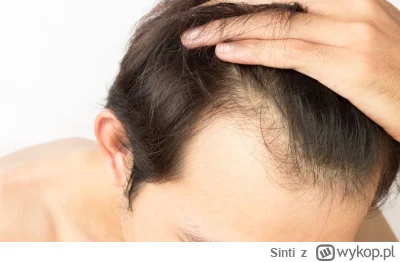 Sinti - nawiedziło cię łysienie androgenowe, daj plusa albo w ciągu kilku miesięcy za...