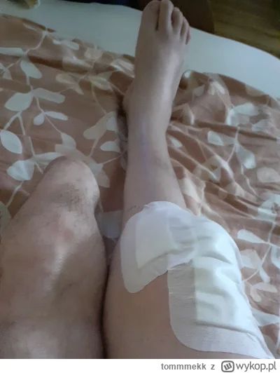 tommmekk - Witam
Tydzień temu Przeszedłem operacje prawego kolana
Ładnie się goi
http...