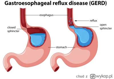 chud - Mirki poddaje sie, choruje juz kilka lat na GERD, 5 gastrologów nic nie pomogł...