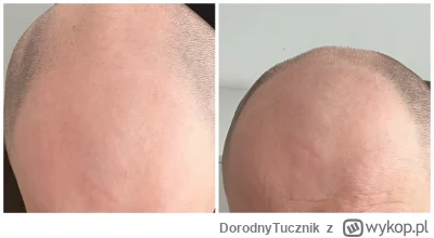 DorodnyTucznik - #przeszczepzwykopem #przeszczepwlosow #lysienie #turcja 
Panowie, ch...