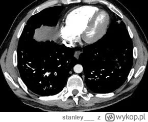 stanley___ - #medycyna #radiologia

Czy tomografia komputerowa niskodawkowa może być ...