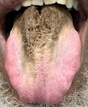 cheeseandonion - Coated/hairy tongue develops when the keratin accumulates more than ...