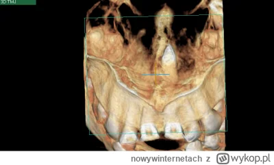nowywinternetach - @Raptrax: @SarahC Jeszcze inny przekrój z tomografii