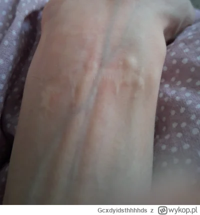 Gcxdyidsthhhhds - Mam taką blizne #przegryw