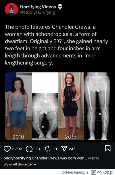 GoldenJanusz - kobieta urodziła się karłem, nie spodobało jej się to więc ze 106 cm z...