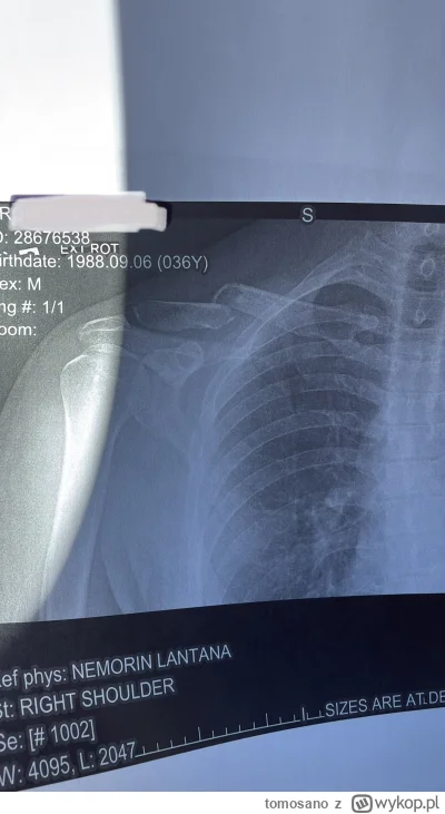 tomosano - Nawiązując do wpisu mirka @michal-g88 który prosił o radę po złamaniu oboj...