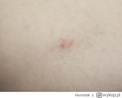 Heretnik - Mirki kilka dni temu znalazłem wczepionego w skórę kleszcza i wyrwałem go ...