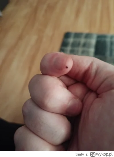 trinty - #przegryw #pytaniedoeksperta #lekarz     co to je na palcu?