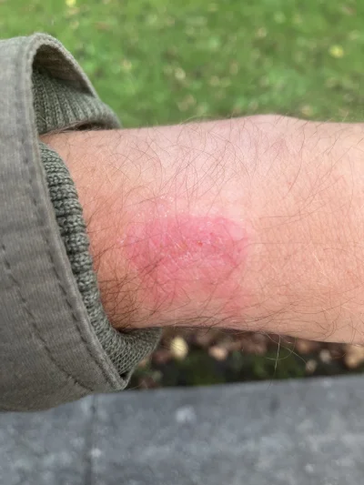 ChlopoRobotnik2137 - Też macie takie odparzenia od #garmin ? Jak te wszystkie susajer...