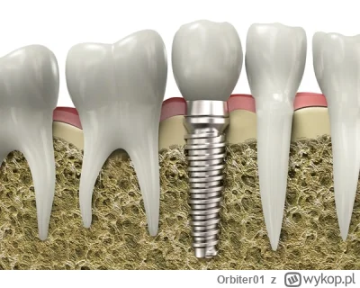 Orbiter01 - JEST COŚ LEPSZEGO IMPLANT DENTYSTYCZNY Po co komuś nowy ,prawdziwy ząb" s...