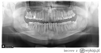 becvvv - Dentysta mi powiedział (jeszcze przed zrobieniem rtg), że wszystkie ósemki l...