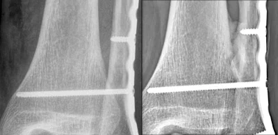 Kemosz - Prawie 9 miesięcy temu złamałem nogę, złamana kość strzałkowa i fragment pis...