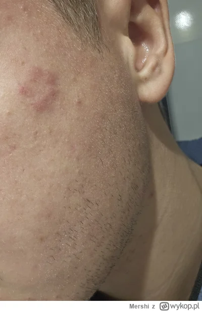 Mershi - Co to za g---o mi wyskoczyło? #tradzik #zdrowie