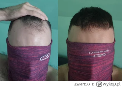 Zwierz33 - @Just_Jump: Dodam tylko, że ja mam zakola na pół głowy, plus z tylu mocne ...
