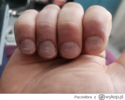Paciolibre - Hej moje paznokcie wyglądają jak na zdjęciu. Mam problem z wrastającymi ...