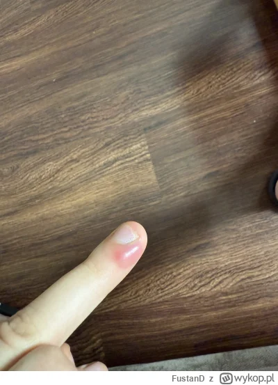 FustanD - Mam pytanie, od dwóch trzech dni bolał mnie palec, ale wtedy nie reagowałem...