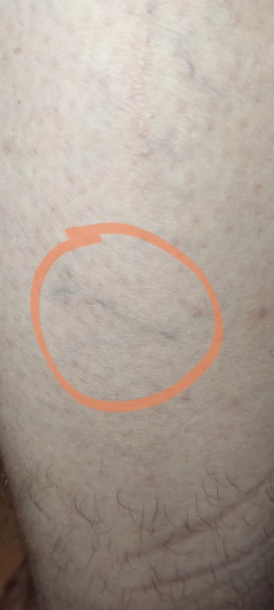 Milo900 - Cierpię na nerwicę lękową zwiazana z moim stanem zdrowia. Przez ostatnie mi...