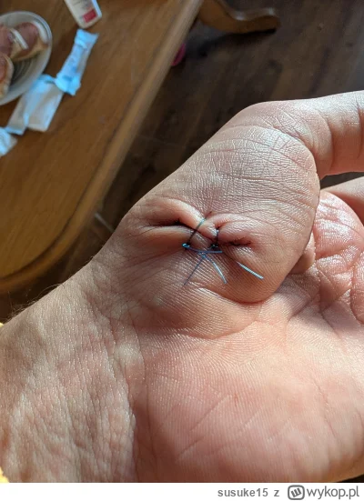 susuke15 - Zszywanie ran na NFZ. Ta skóra po zdjęciu się wyprostuje? #medycyna