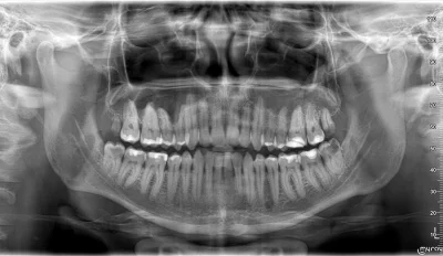 retropedro666 - #stomatologia #nfz #zęby #pytaniedoeksperta 

cztery 8 do wyrwania. C...