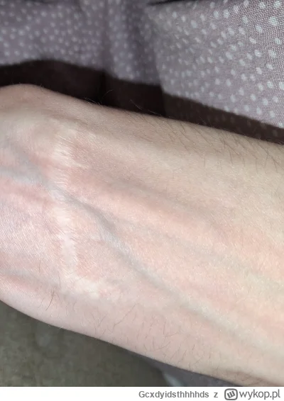 Gcxdyidsthhhhds - #przegryw blizna na ręce po wybiciu szyby w drzwiach ヽ(☼ᨓ☼)ﾉ