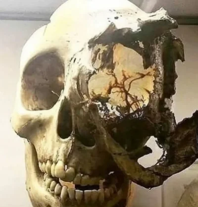 PixelNomad - Ta czaszka pokazuje, co zaawansowany rak może właściwie zrobić z ludzkim...