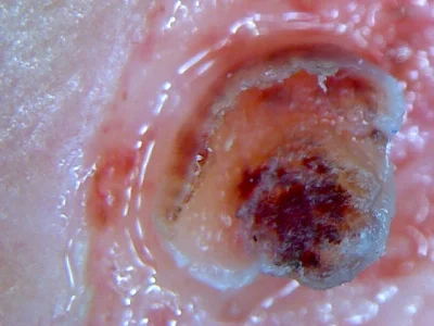 KollA - Co to, HPV, inny glut? (łytka, 2mm)

#dermatologia #medycyna