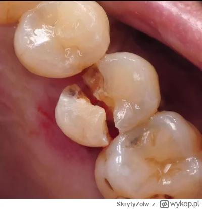 SkrytyZolw - Dlaczego regularna kontrola RTG u dentysty jest ważna? Odpowiedź na zdję...