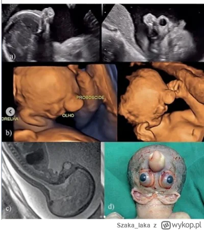 Szakalaka - @Szakalaka:  USG 2D/3D, rezonans magnetyczny i widok czołowy noworodka wy...