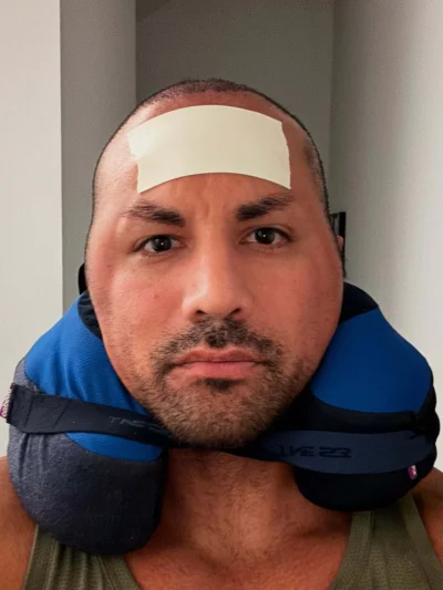 raszko754 - Guzman przeszczepił włosy,  po zabiegu spuchł jak balon. Teraz pewnie zno...