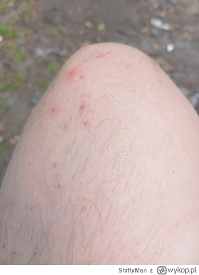 ShiftyMan - Mam pytanie do mądrych ludzi lub dermatologów, a dokładniej chodzi mi o t...
