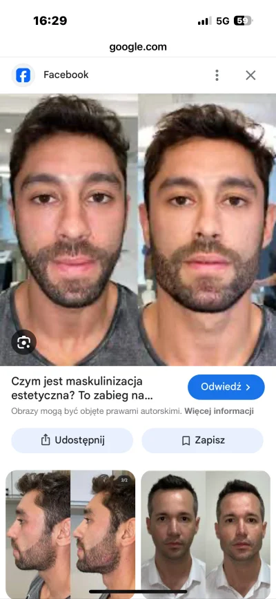 kamileon25 - Czy ktoś z was ma implant żuchwy? Polecacie jakiegoś chirurga który wam ...