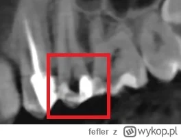 fefler - Czy ten ząb ma próchnicę czy co to jest to czarne? 

#zeby #stomatologia #de...