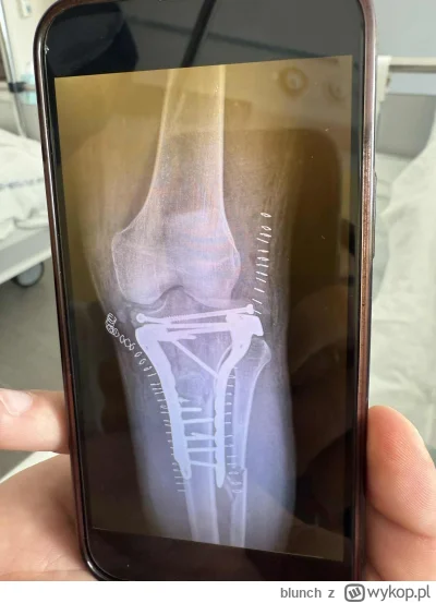 blunch - @pieknylowca u mnie to bardziej skomplikowana historia :) Złamanie w Grecji,...