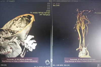 AlexBrown - Czy mamy na sali radiologa? Mam wyniki tk angio. Widzę dwie wizualizacje:...