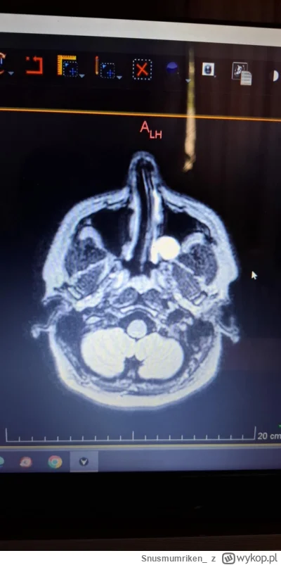 Snusmumriken - @Snusmumriken wszystko sie zgadza, mam wiecznie z------e zatoki, i mia...