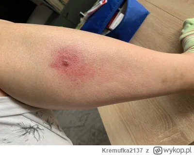 Kremufka2137 - OSTRZEGAM BRZYDKIE ZDJECIA JESLI KOGOS TRIGGERUJĄ JAKIES DERMATOLOGICZ...